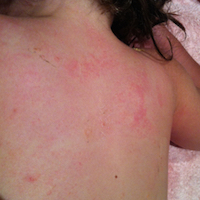 Picture of molluscum on back of young child.