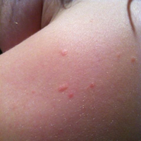 Young girl with molluscum on her back before treatment with Mollenol.