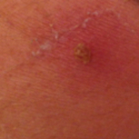 Molluscum contagiosum pus head treatment with mollenol.