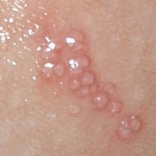 molluscum-dots-now-inflamed.jpg