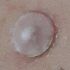 Molluscum patches from Mollenol