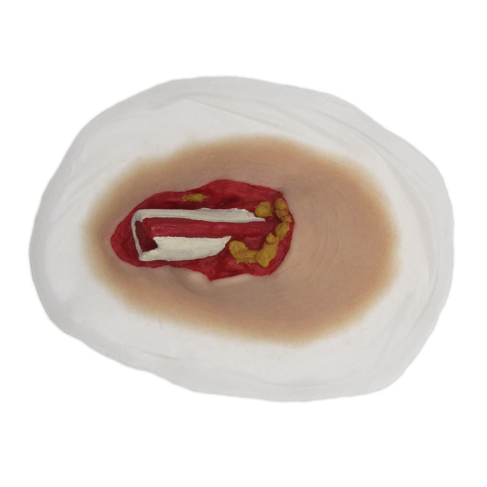 SiMoulage™ SFX Silicone Small Open Fracture (Suitable For Radius, Ulna,Fibula,Clavicle & Rib)