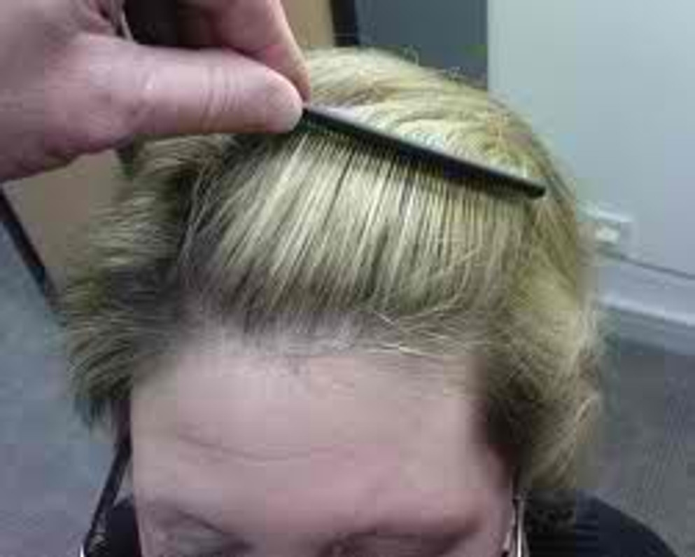 Frequent Causes Of Hair Loss In Women Body4real
