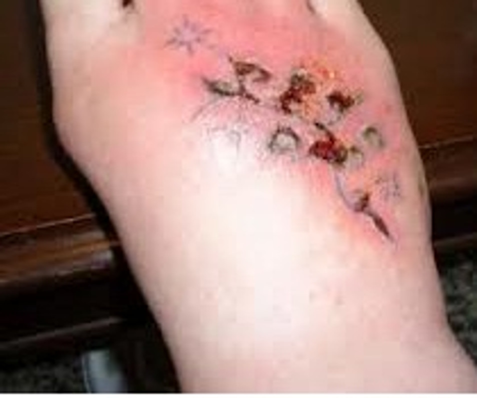 What You NEED To Do If Your Tattoo Gets Infected  YouTube