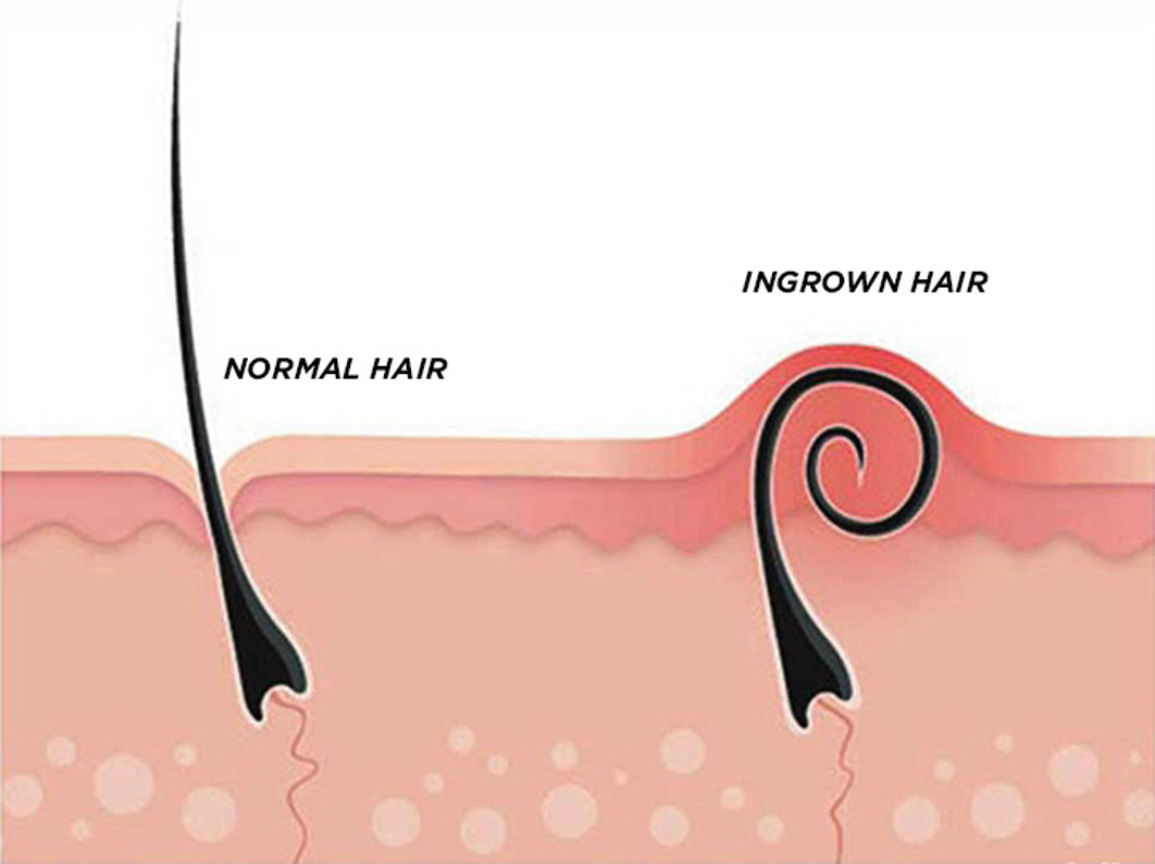 INGROWN HAIR REMOVAL KIT THAT WORKS  Body4Real