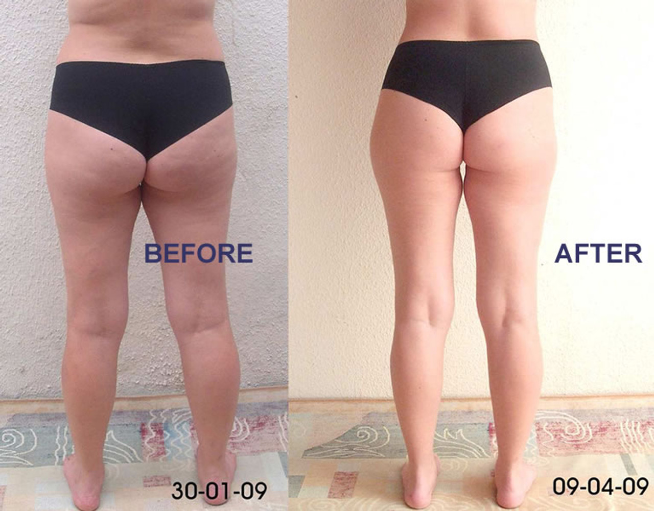 Brazilian Bermuda Shapewear for cellulite elimination l