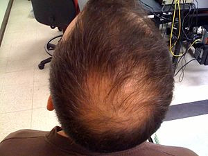 ALOPECIA THE MOST FREQUENT CAUSE OF HAIR LOSS Body4Real