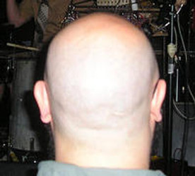 METHODS TO EFFECTIVELY TREAT ANDROGENETIC ALOPECIA