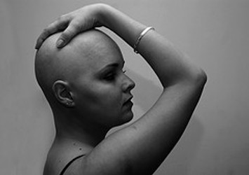 IS MINOXIDIL A RELIABLE SOLUTION FOR HAIR LOSS?