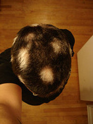 TREATMENT FOR HAIR LOSS