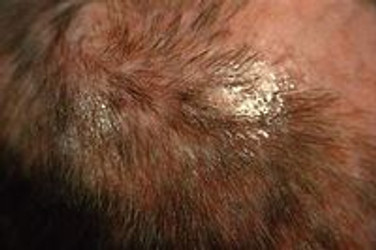 WHAT IS DANDRUFF? CAN IT CAUSE HAIR LOSS?