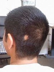 WHY IS IT THAT WE EXPERIENCE HAIR LOSS?