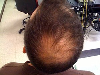 UNDERSTANDING ANDROGENETIC ALOPECIA
