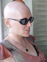 HAIR LOSS IN WOMEN