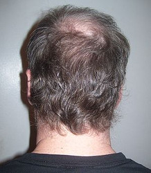 ANDROGENETIC ALOPECIA – THE MOST FREQUENT CAUSE OF HAIR LOSS