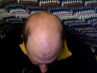 METHODS TO PREVENTING AND TREATING MALE PATTERN HAIR LOSS