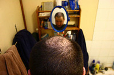 HOW TO PROPERLY TREAT MALE PATTERN BALDNESS