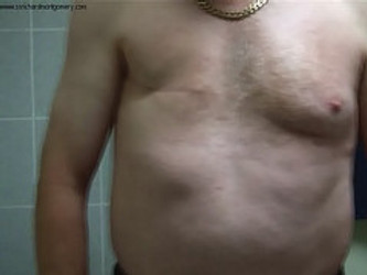 WELL-KNOWN HAIR LOSS TREATMENT MAY CAUSE MALE BREAST CANCER