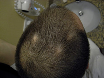 COMMON CAUSES OF HAIR LOSS IN CHILDREN