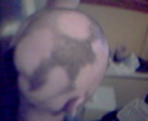 THE TRUTH ABOUT HAIR LOSS