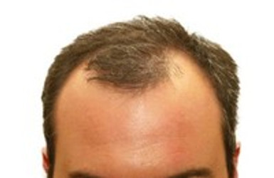 WHAT IS CAUSING HAIR LOSS?