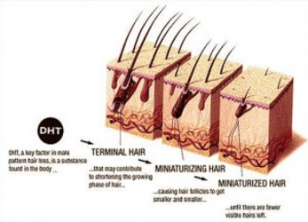 IS DHT THE ACTUAL CAUSE OF HAIR LOSS?