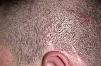 FOLLICULITIS CAN CAUSE HAIR LOSS