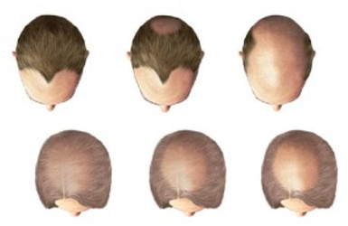 UNDERSTANDING WHAT’S CAUSING HAIR LOSS BEFORE BUYING ANY TREATMENTS