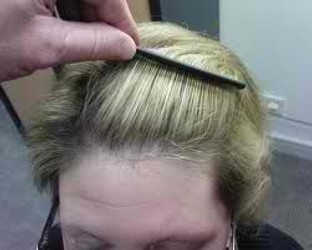FREQUENT CAUSES OF HAIR LOSS IN WOMEN