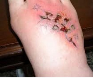 DO YOU HAVE AN INFECTED TATTOO?