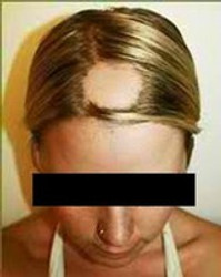 HAIR LOSS AMONG YOUTH IS ON THE RISE