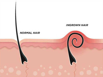 PREVENT INGROWN HAIRS, RAZOR BUMBS, RASH AND CUTS WITH PRIVA SHAVE