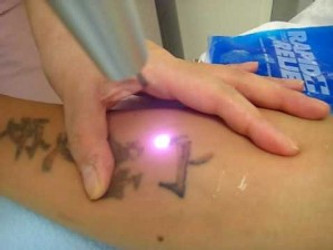 LASER TATTOO REMOVAL TREATMENT AND COST