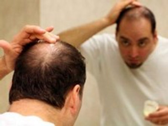TYPICAL CAUSES OF HAIR LOSS