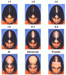 HOW TO PREVENT HAIR LOSS IN WOMEN