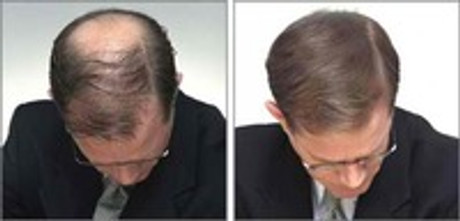 HIDE YOUR BALD SPOTS, HAIR LOSS OR THINNING WITH NANOGEN NANOFIBERS