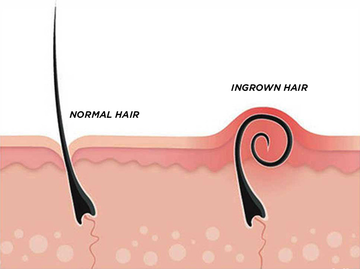 How to Prevent Ingrown Hair on your Face  Neck  Philips Norelco