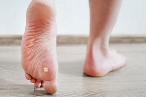 How to prevent verrucas in children 