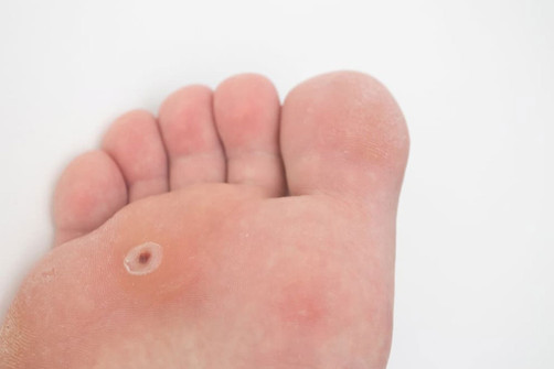 How to treat a verruca on a child