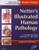 Netter's Illustrated Human Pathology Updated Edition: with Student Consult Access, 1e