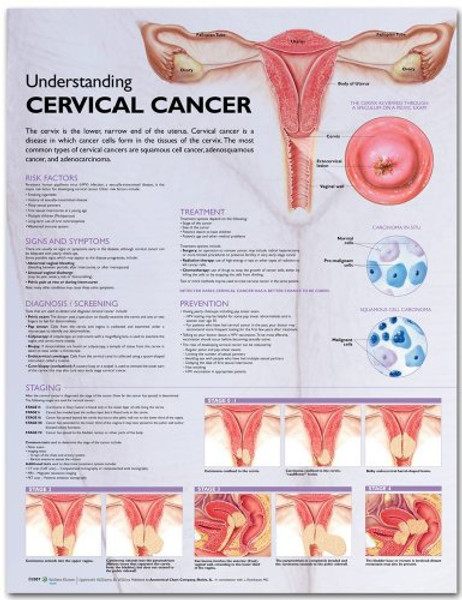 Understanding Cervical Cancer Anatomical Chart