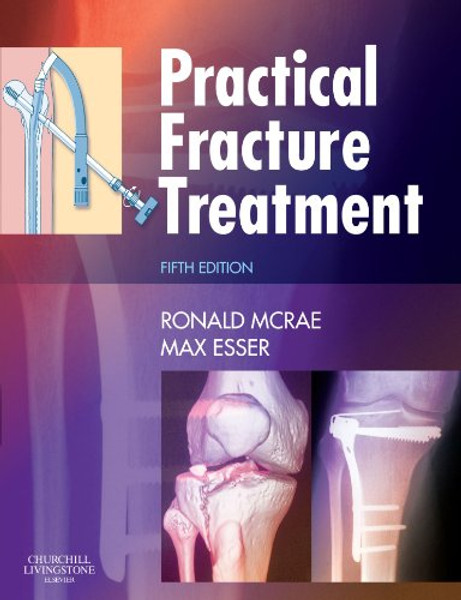 Practical Fracture Treatment, 5e