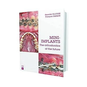 Mini-Implants