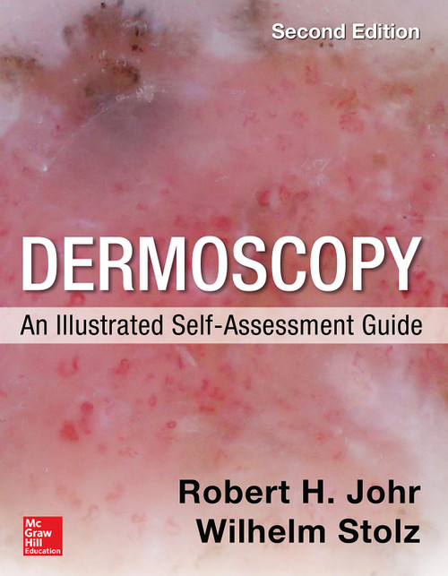 Dermoscopy: An Illustrated Self-Assessment Guide,