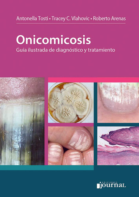 Onicomicosis [Spanish Edition]