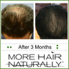 More Hair Naturally 9: Advanced Stem Cell Therapy For Thinning Hair. Helps Promote Healthier, Thicker and stronger hair growth