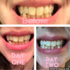 Dr Song Teeth Whitening Gel Refill 4X Syringes 35% Carbamide Peroxide