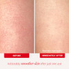 First Aid Beauty - KP Bump Eraser Body Scrub with 10% AHA, Keratosis Pilaris Exfoliator with Glycolic and Lactic acids, Helps Reduce Chicken Skin Bum