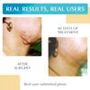 Advanced Silicone Scar Treatment Sheets for OLD, NEW Scars, Surgery, Keloids