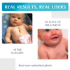 Advanced Silicone Scar Treatment Sheets for OLD, NEW Scars, Surgery, Keloids